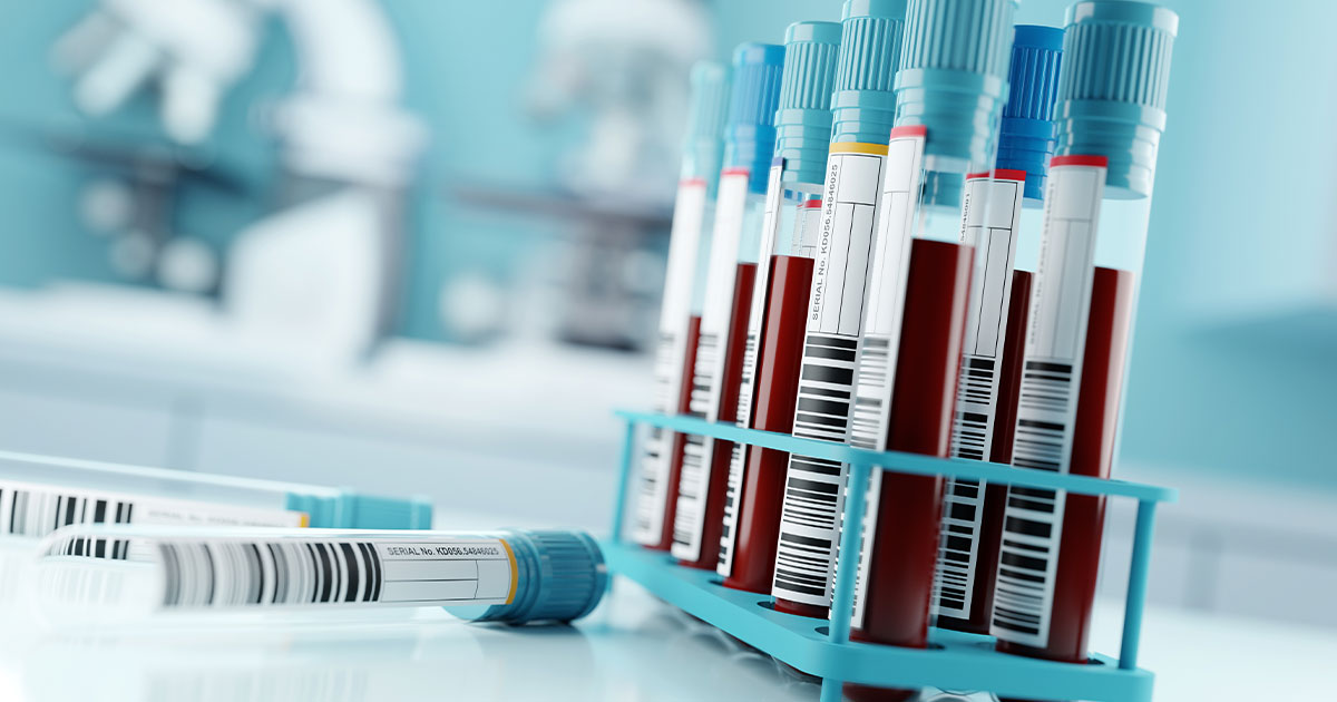 prostate cancer-isopsa-psa test