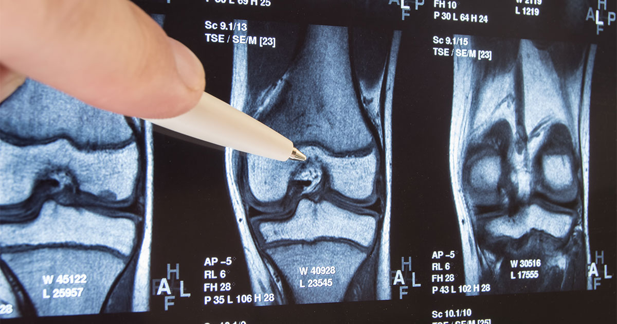 elective joint replacement-healthcare-broken bone-orthopedic surgery
