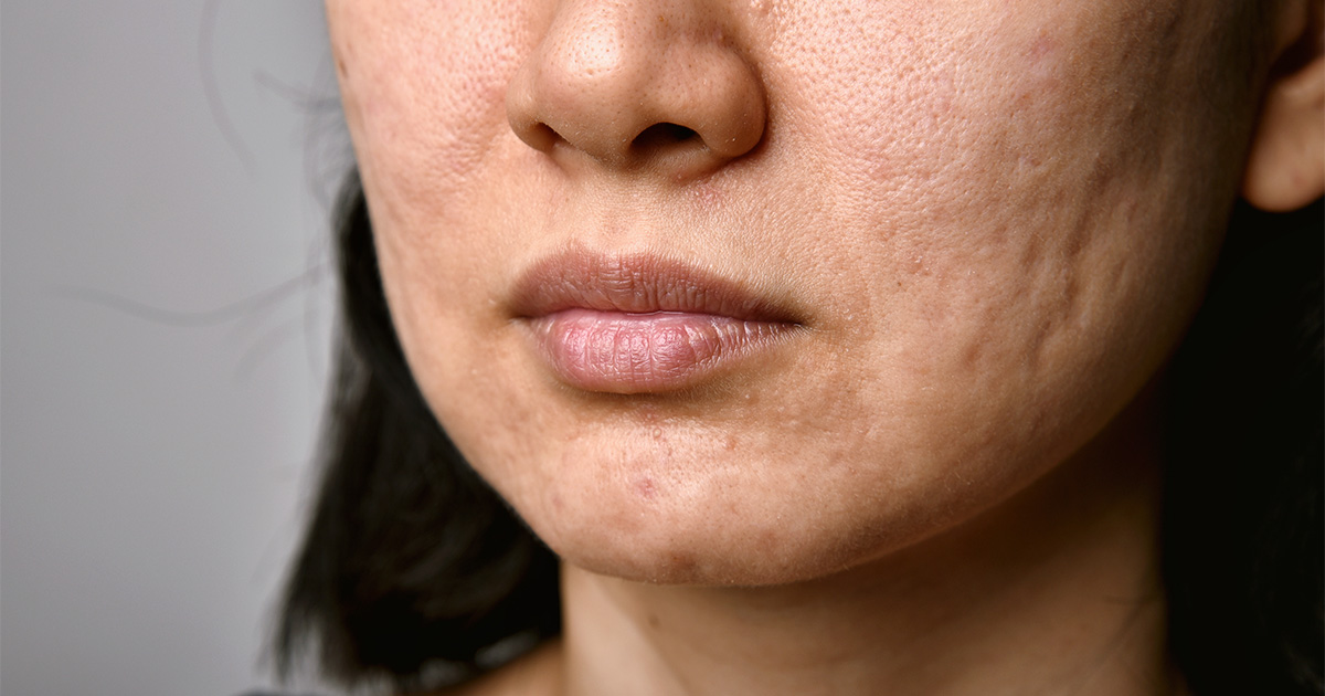 Acne scars-dermatologist-scarring-acne-collagen