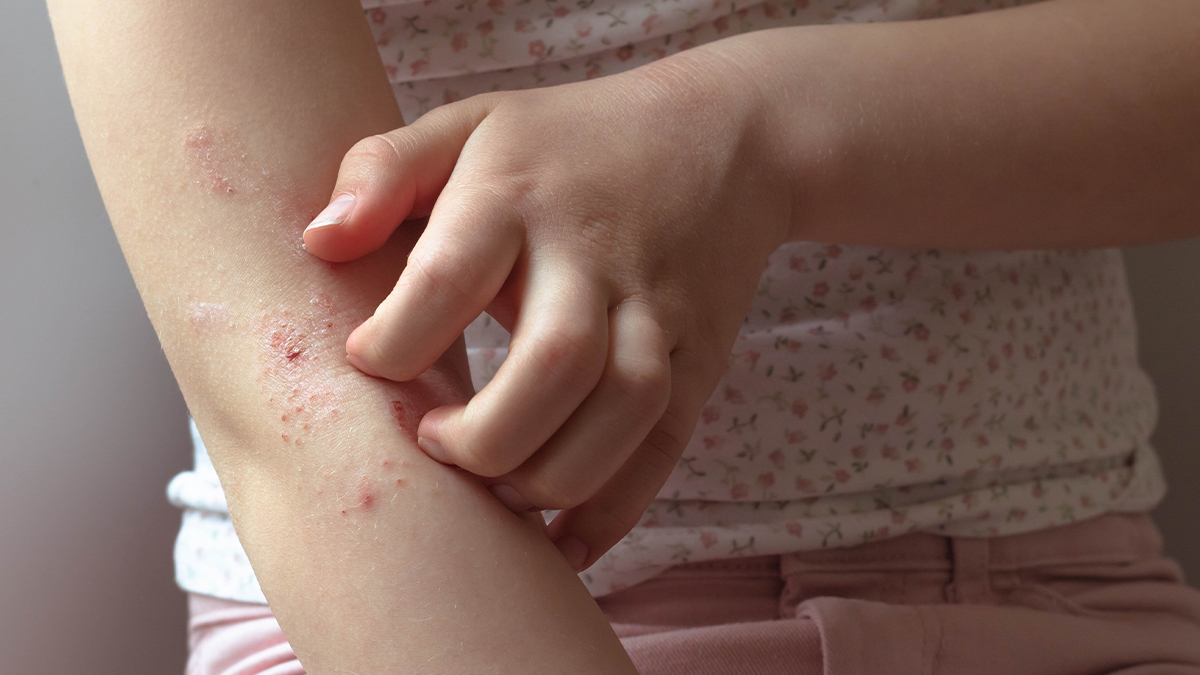 Pediatric-Sarcoidosis-skin-health-children