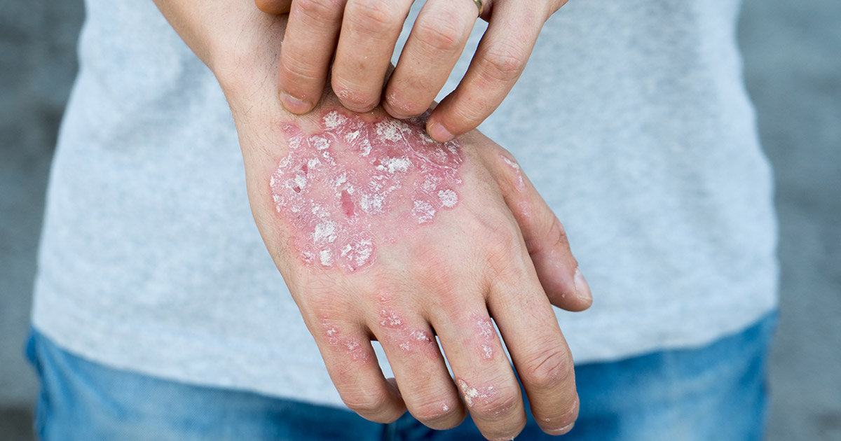 A person with psoriasis scratching their inflamed hand