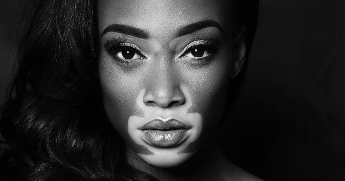 Winnie Harlow