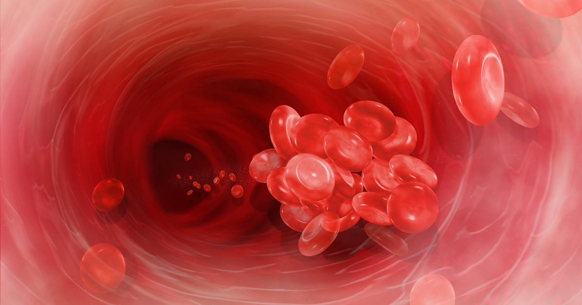 blood cloth thrombosis canada