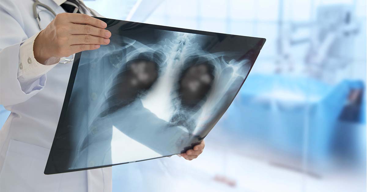 lung cancer