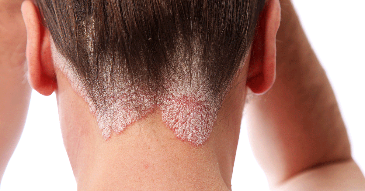 psoriasis skin condition on neck