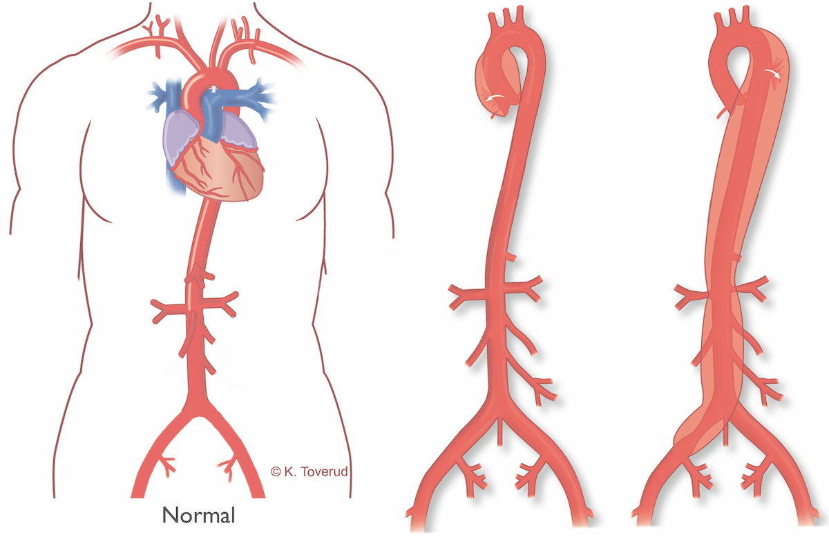 aorta illustration
