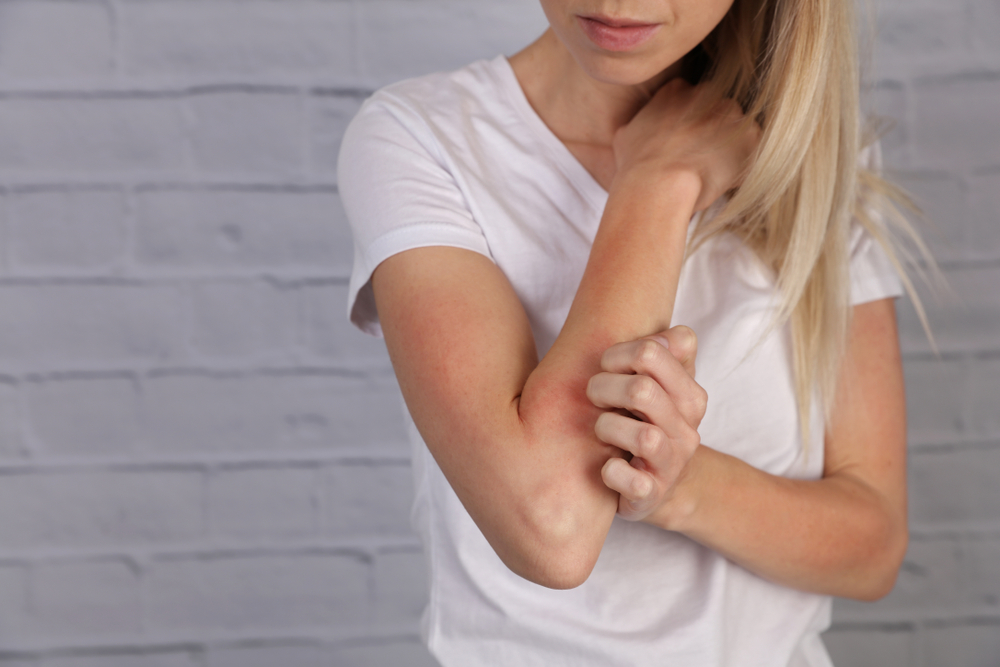 atopisk dermatit