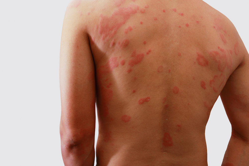 Atopisk dermatit