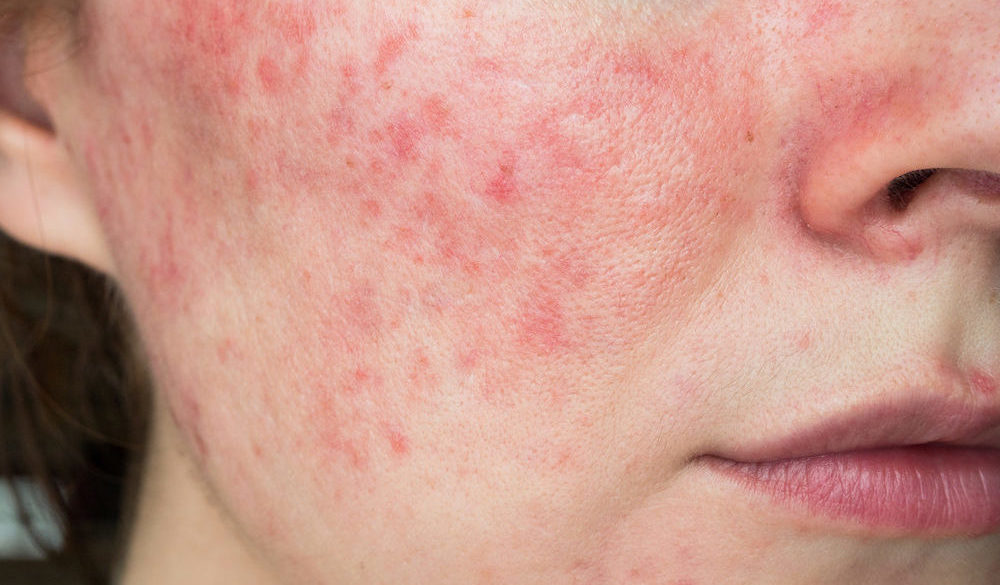 rosacea