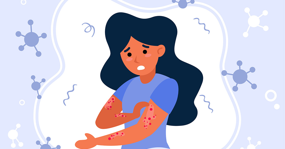 atopic dermatitis