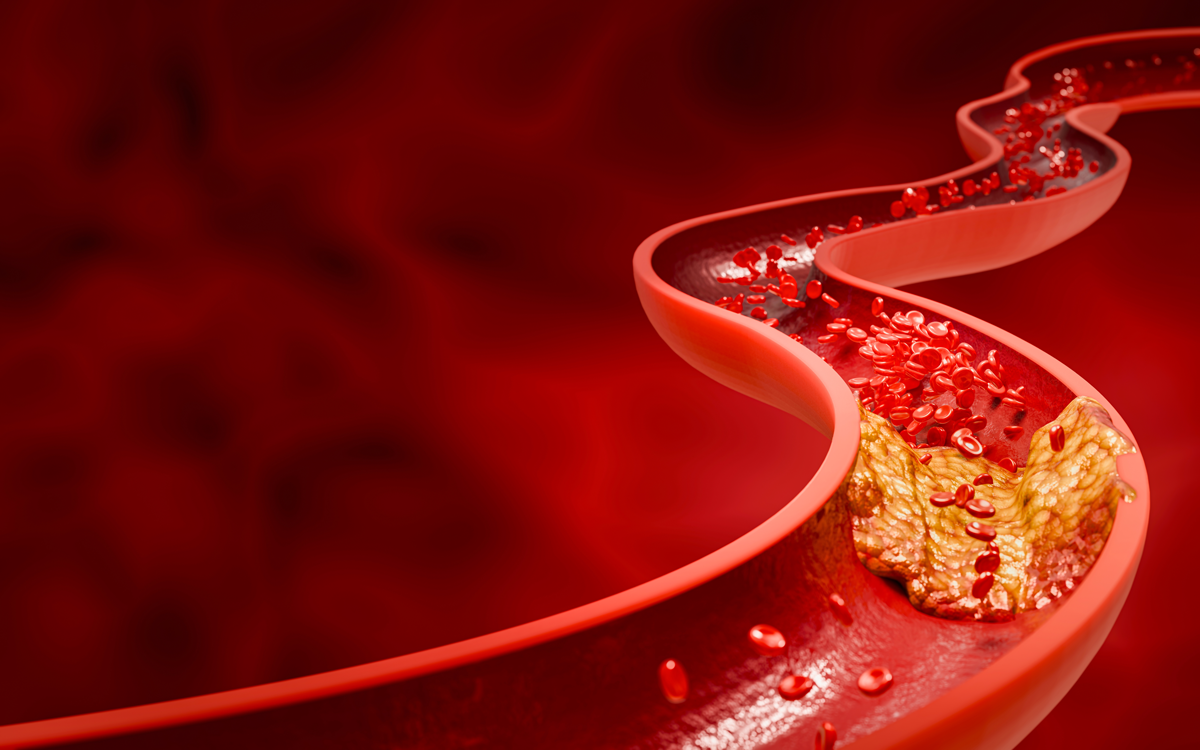 Hyperlipidämie oder Arteriosklerose. Blockiertes Arterienkonzept und menschliches Blutgefäß als Erkrankung mit Cholesterin-Fettansammlung und Verstopfung. Verstopfte Arterien, Cholesterinplaque in der Arterie. 3D-Darstellung