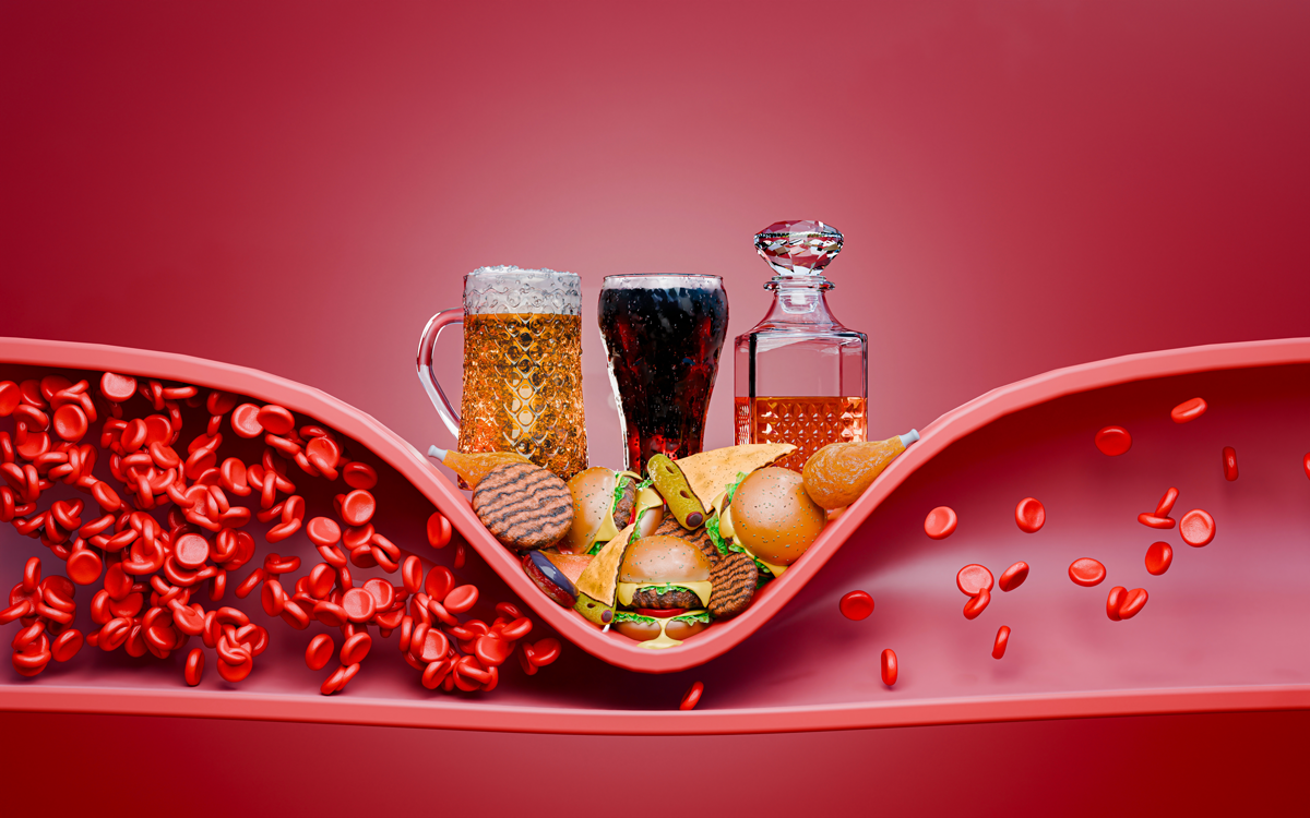 Hyperlipidämie oder Arteriosklerose. Blockiertes Arterienkonzept und menschliches Blutgefäß als Erkrankung mit Cholesterinfett. Verstopfte Arterien, Cholesterinspiegel. Fast Food, Junkfood. 3D-Darstellung