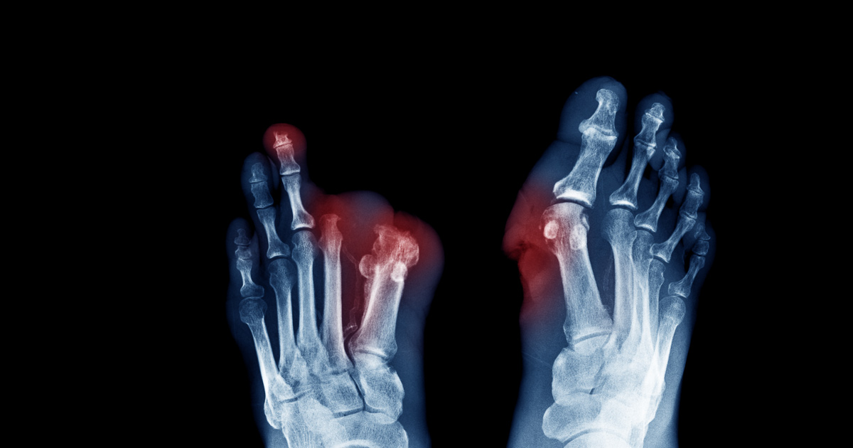 diabetic foot