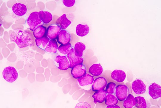 blood smear is often used as a follow-up test to abnormal results on a complete blood count (CBC) to evaluate the different types of blood cells.Medical science background showing blast cells(AML)