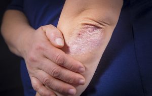 Psoriasis on elbows. Black background
