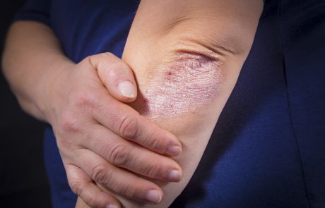 Psoriasis on elbows. Black background