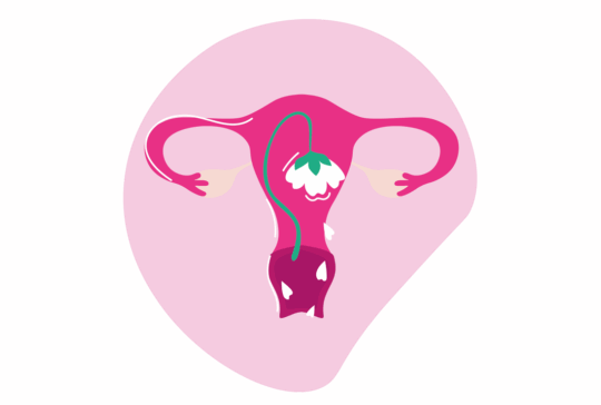 Thrush, allgemein bekannt als Candididiasis, ist eine Pilzinfektion, die Beschwerden hervorruft und häufig die Genitalbereiche von Frauen oder die Mundhöhle betrifft