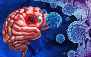 Gliomkrebs Tumor als Ausbruch bösartiger Zellen als eine Gehirnkrankheit angreifen Neuronen als medizinisches Konzept der neurologischen Krankheit mit 3D-Illustrationselementen.