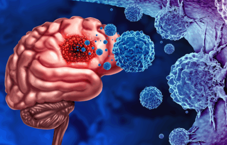 Gliomkrebs Tumor als Ausbruch bösartiger Zellen als eine Gehirnkrankheit angreifen Neuronen als medizinisches Konzept der neurologischen Krankheit mit 3D-Illustrationselementen.