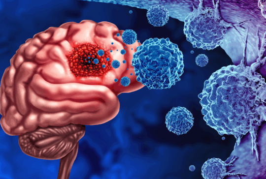 Gliomkrebs Tumor als Ausbruch bösartiger Zellen als eine Gehirnkrankheit angreifen Neuronen als medizinisches Konzept der neurologischen Krankheit mit 3D-Illustrationselementen.