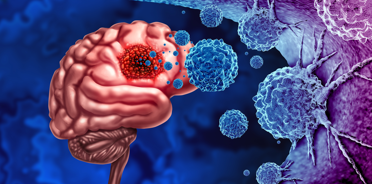 Gliomkrebs Tumor als Ausbruch bösartiger Zellen als eine Gehirnkrankheit angreifen Neuronen als medizinisches Konzept der neurologischen Krankheit mit 3D-Illustrationselementen.