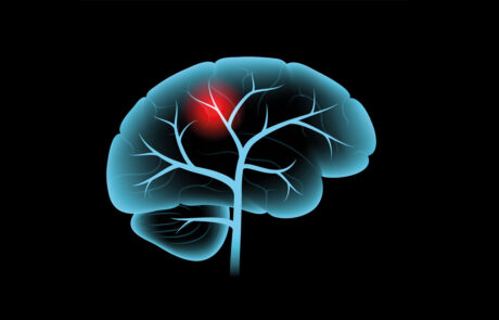 Schlaganfall des Gehirns, hämorrhagische und ischämische Probleme. Schmerzen im menschlichen Kopf. Arteriosklerose, Infarkt, Ischämie, Thromboseerkrankung. Cholesterin in menschlichen Blutgefäßen. Medizinisches Poster, Vektorgrafik.
