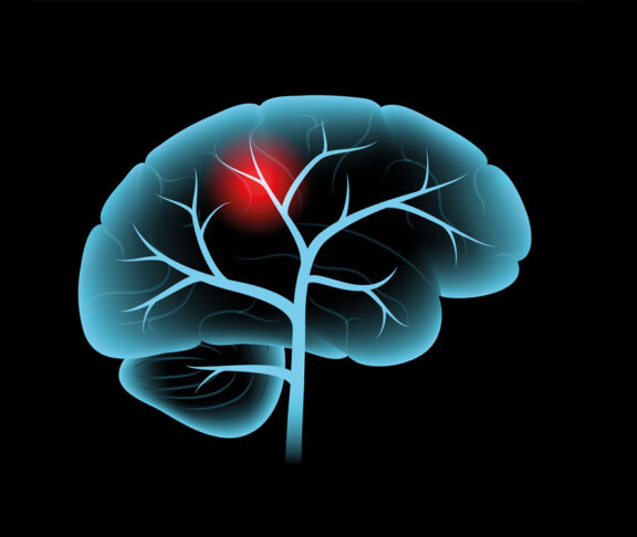 Schlaganfall des Gehirns, hämorrhagische und ischämische Probleme. Schmerzen im menschlichen Kopf. Arteriosklerose, Infarkt, Ischämie, Thromboseerkrankung. Cholesterin in menschlichen Blutgefäßen. Medizinisches Poster, Vektorgrafik.