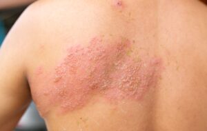 © Shutterstock Typisch für Gürtelrose ist ein Bläschenausschlag, der üblicherweise einseitig auftritt.