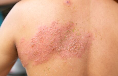 © Shutterstock Typisch für Gürtelrose ist ein Bläschenausschlag, der üblicherweise einseitig auftritt.