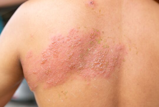 © Shutterstock Typisch für Gürtelrose ist ein Bläschenausschlag, der üblicherweise einseitig auftritt.