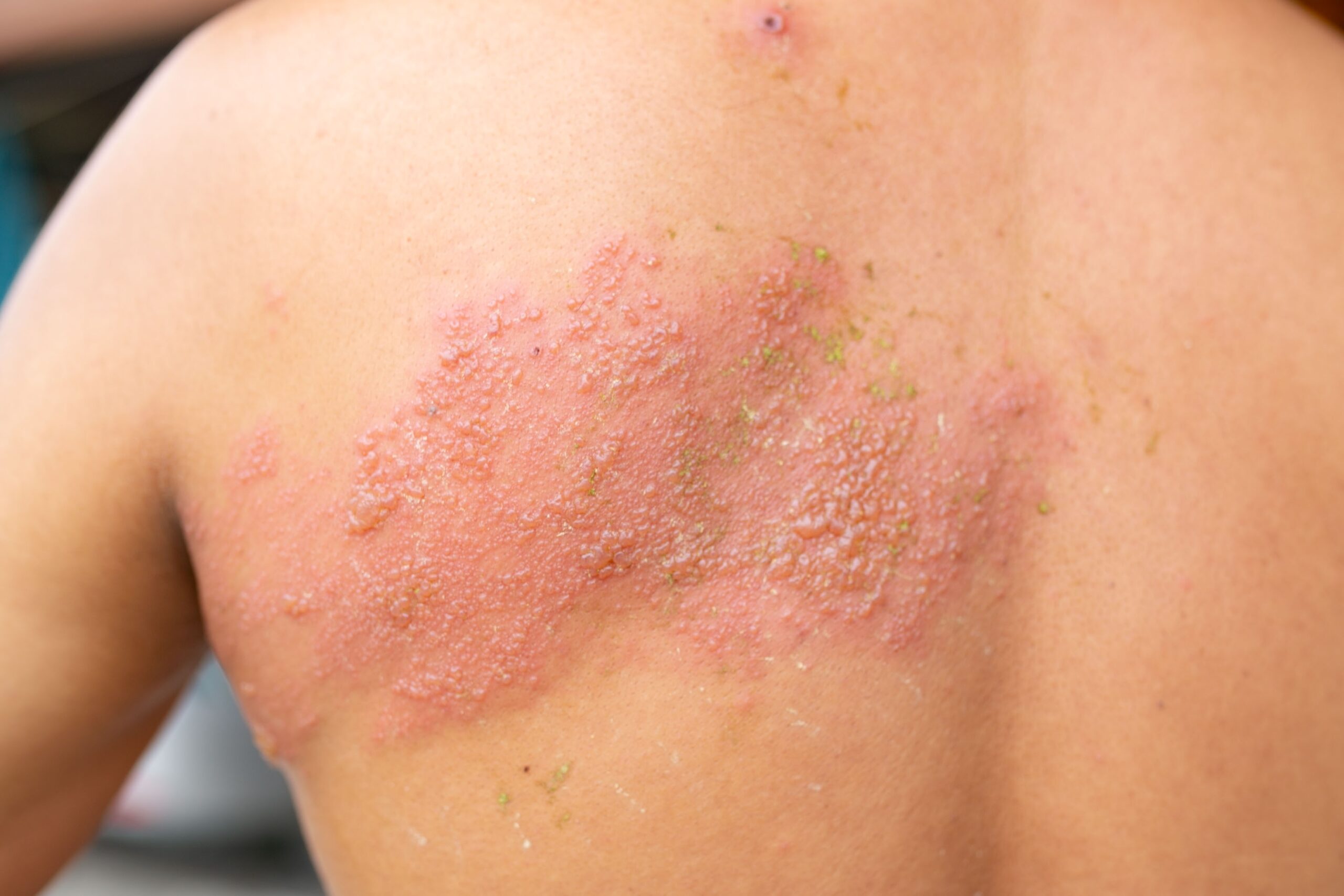 © Shutterstock Typisch für Gürtelrose ist ein Bläschenausschlag, der üblicherweise einseitig auftritt.