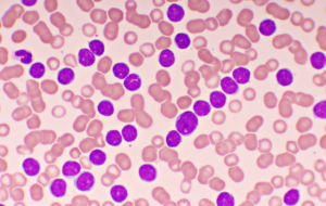 Blood picture of chronic lymphocytic leukemia or CLL, analyze by microscope, original magnification 1000x