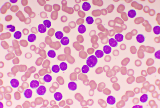 Blood picture of chronic lymphocytic leukemia or CLL, analyze by microscope, original magnification 1000x