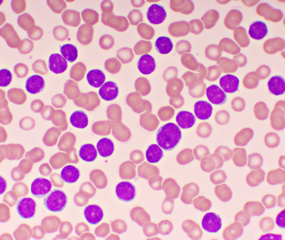 Blood picture of chronic lymphocytic leukemia or CLL, analyze by microscope, original magnification 1000x