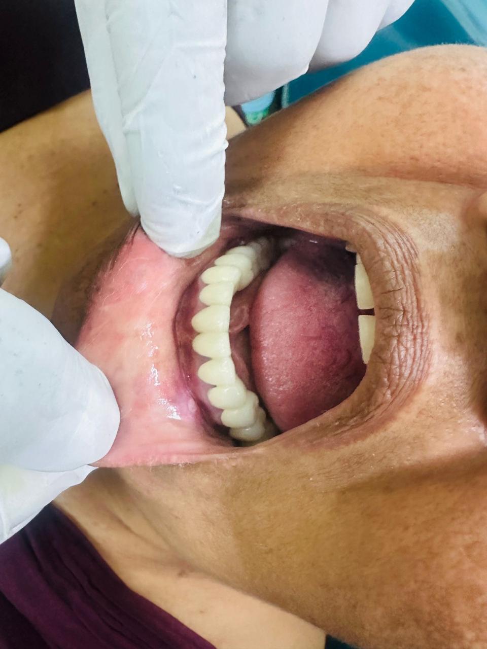 After treatment